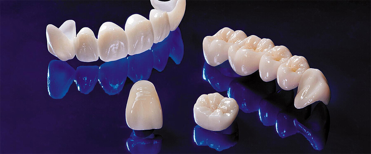 E-max Crowns And Veneer