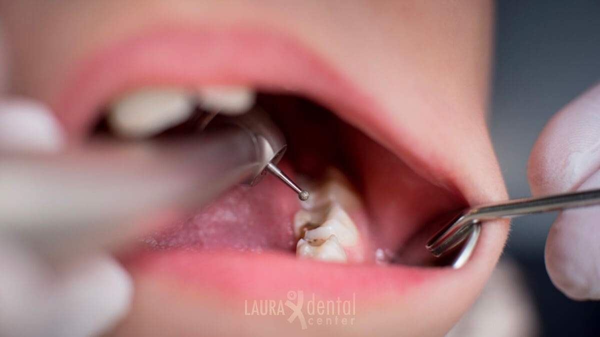 A Close Look at Dental Cavities