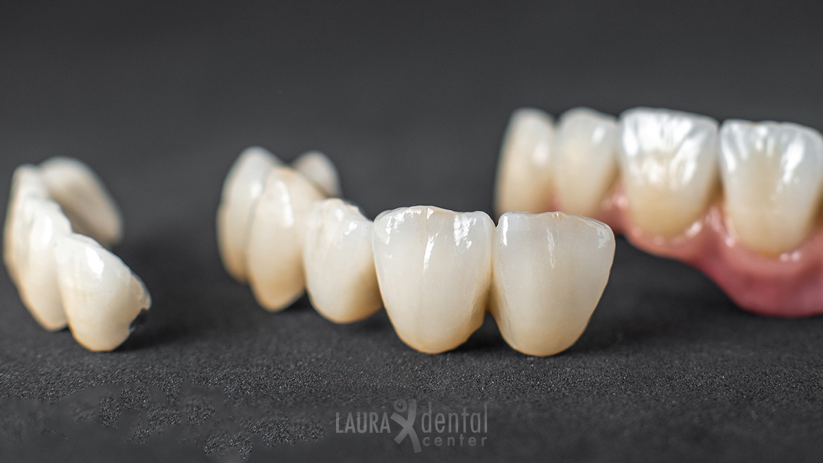 Full Ceramic Crowns – What You Need to Know
