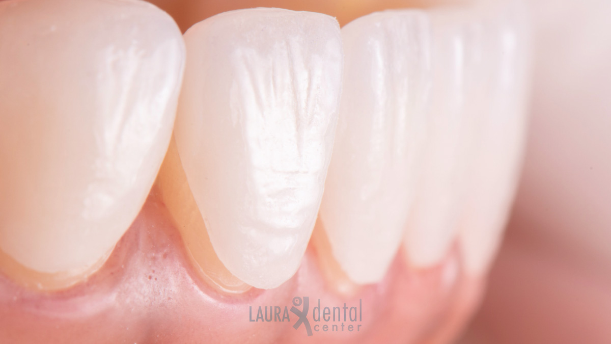 Veneers The Pros and Cons of This Popular Cosmetic Treatment
