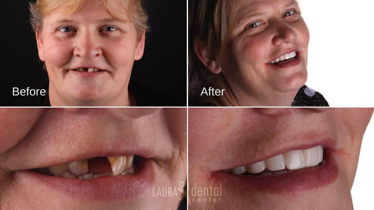 Do Dental Implants Look Realistic?