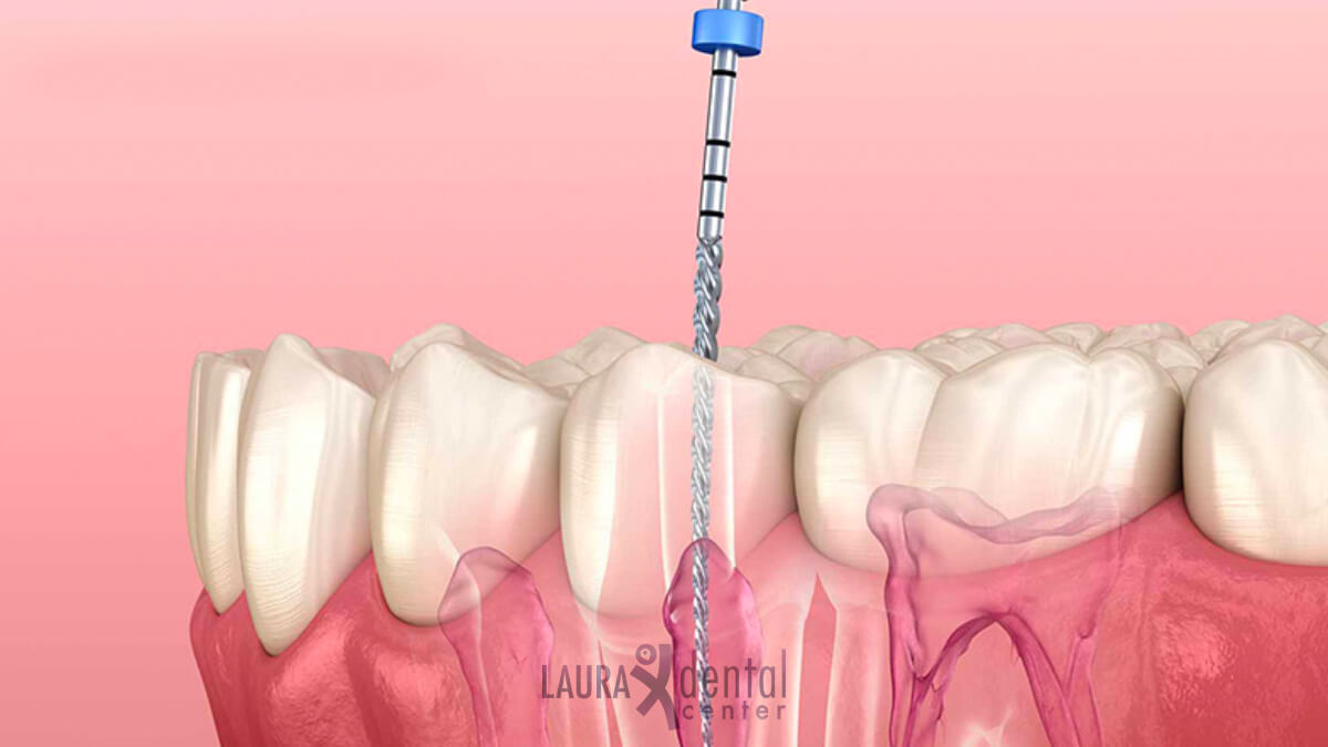 Does Root Canal Treatment Hurt