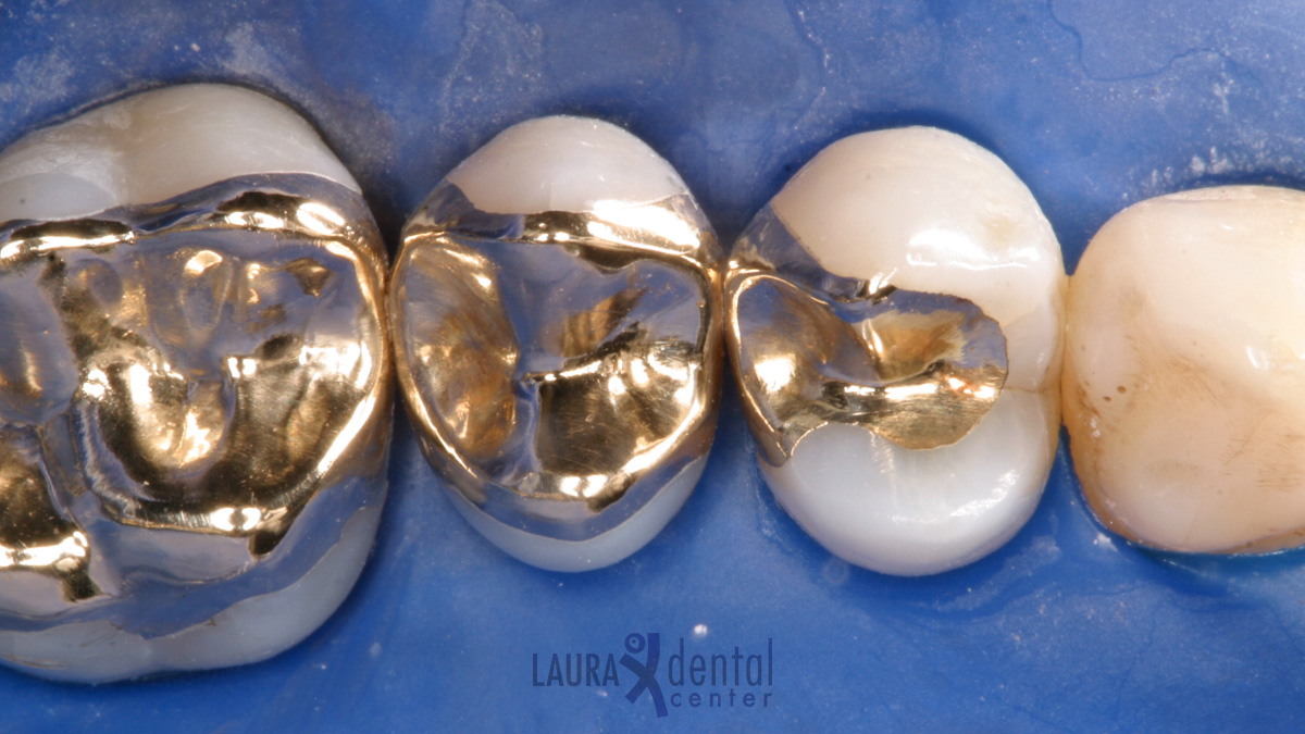What are Inlay – Onlay Fillings How They Are Placed, The Advantages of Them