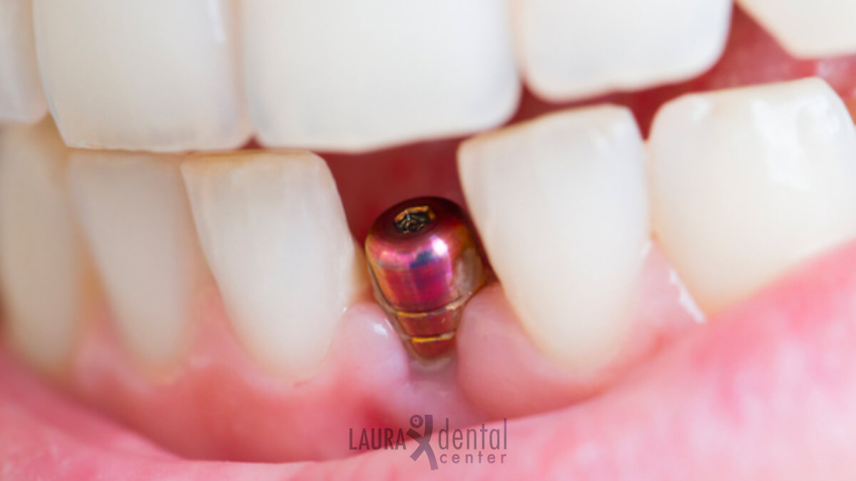 The Benefits of Mini Dental Implants