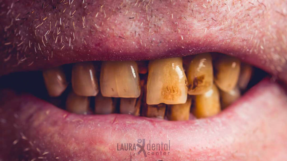 The Dangers of Tobacco Use Impact on Oral Health