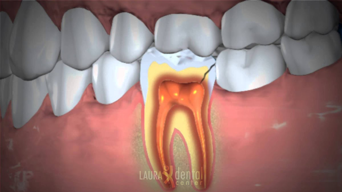 Can Tooth Infection Cause Sinusitis? Be careful!