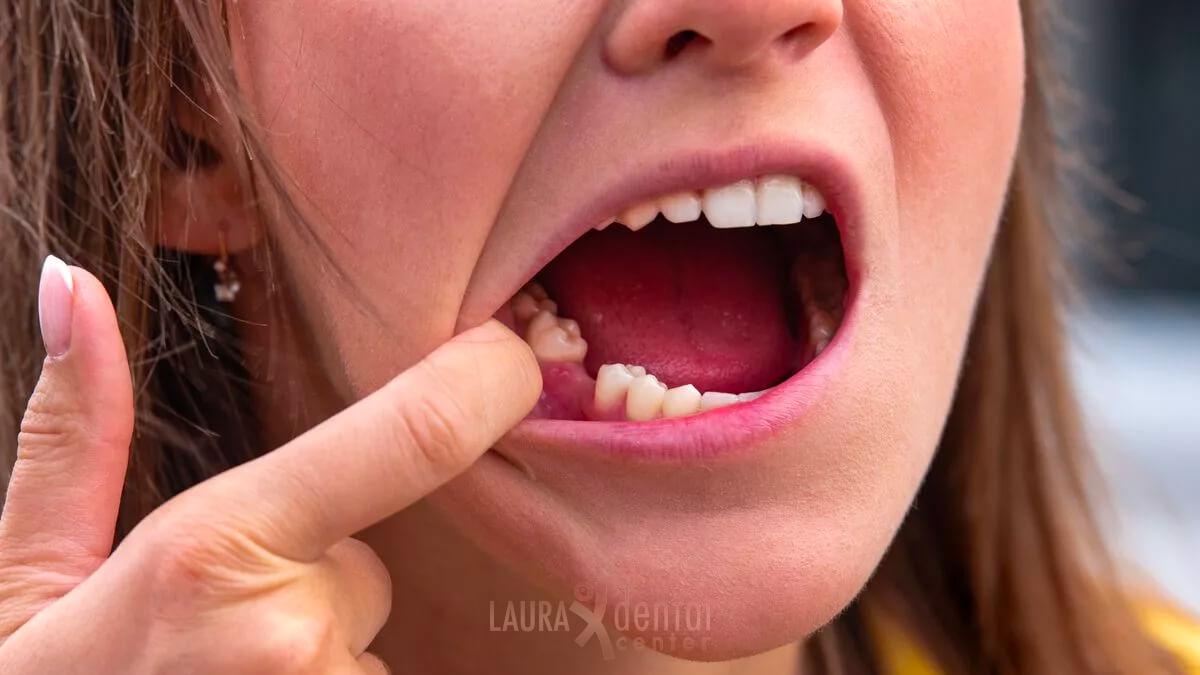 When Can You Eat Solid Food After Tooth Extraction?