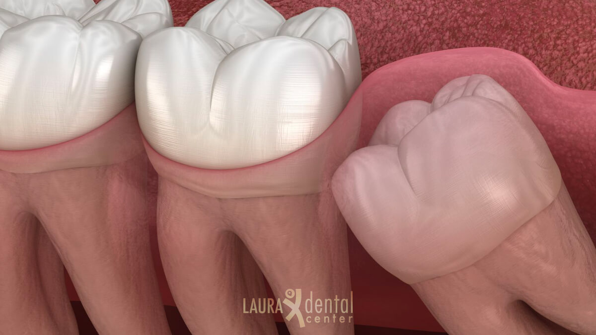 Wisdom Teeth: Why Do We Have Them And What To Do About Them?